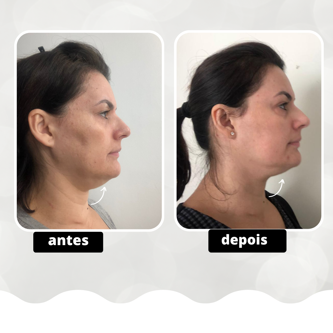 Antes e depois de procedimento (2)