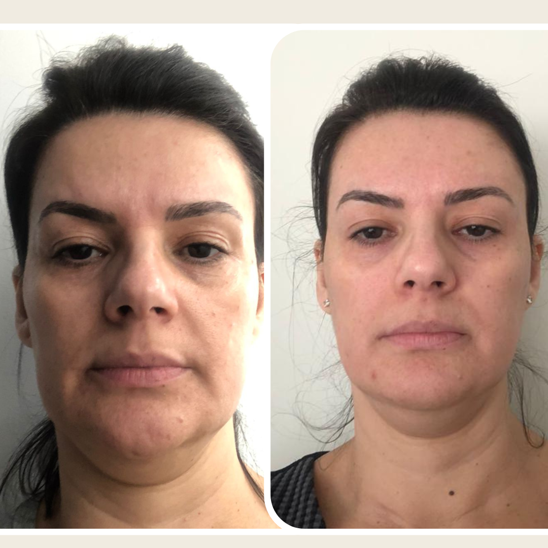 Antes e depois de procedimento (3)