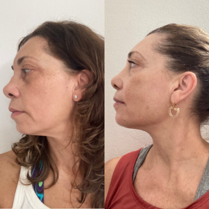 Cópia de ANTES E DEPOIS SONINHA (300 x 300 px)