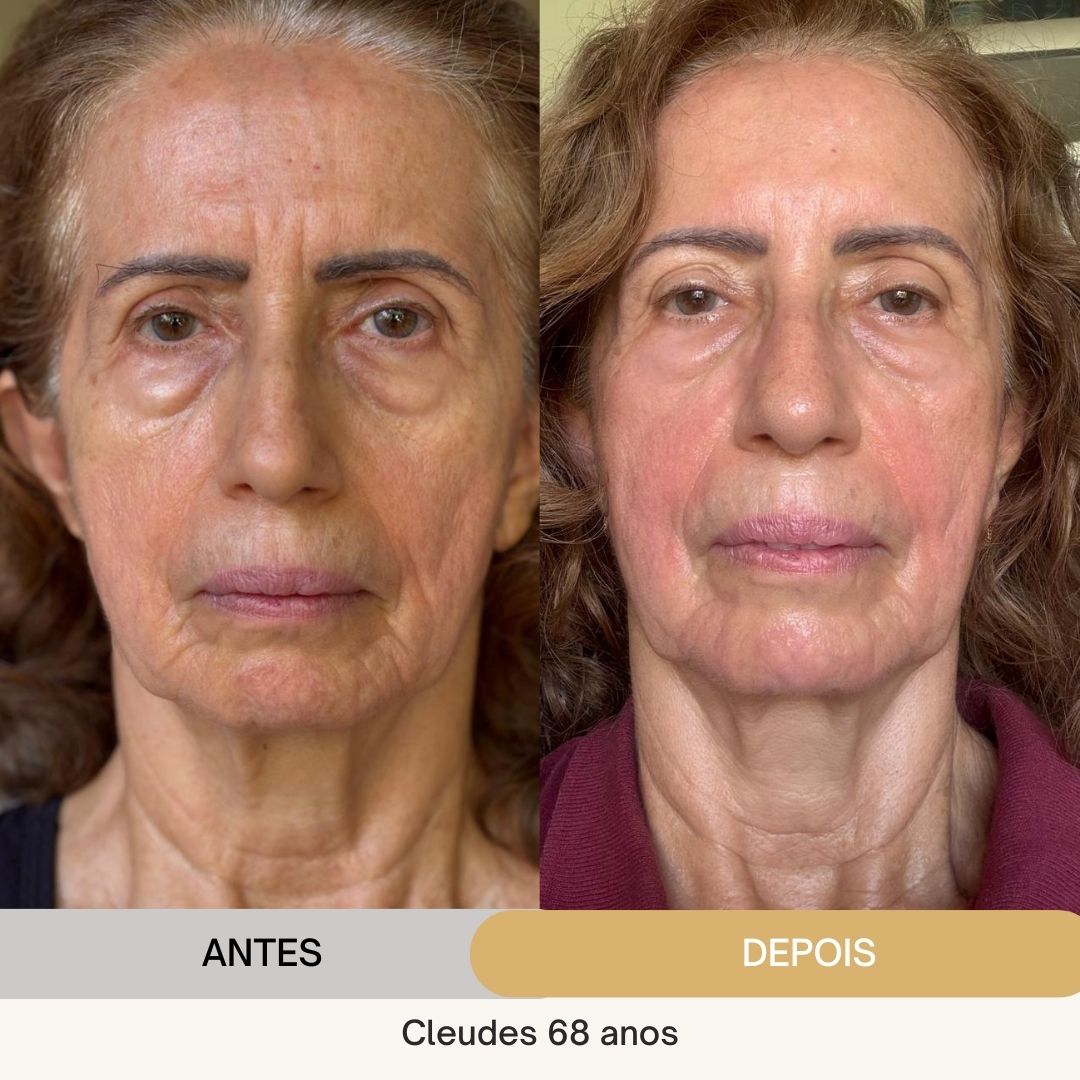 ANTES E DEPOIS (13)
