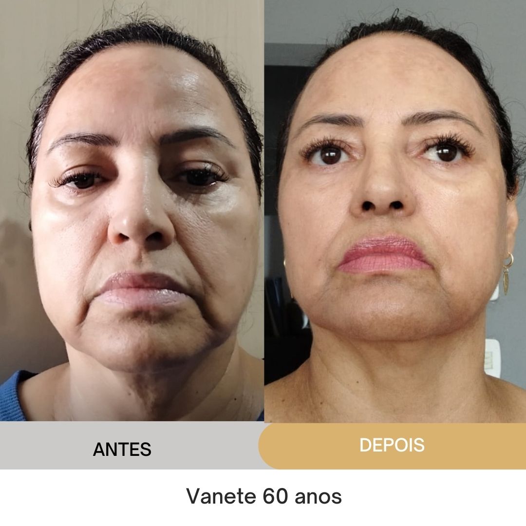 ANTES E DEPOIS (20)
