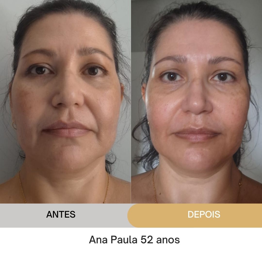 ANTES E DEPOIS (21)