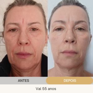ANTES E DEPOIS (9)