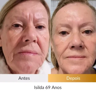 Depoimento Método Rosto Firme - Foto Isilda 69 anos