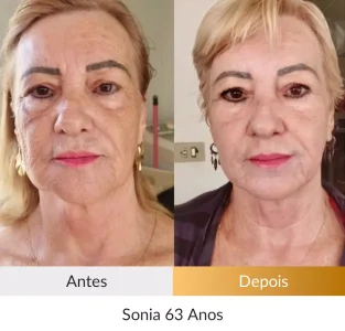 Depoimento Método Rosto Firme - Foto Sonia 63 anos